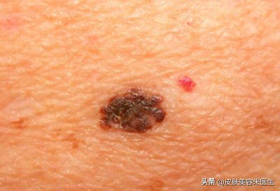 ​黑色素瘤有多严重？不要忽视每一颗“痣”，看完照片2你就知道了